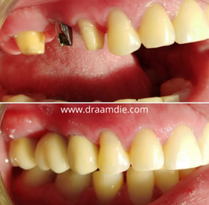 Implantes dentales