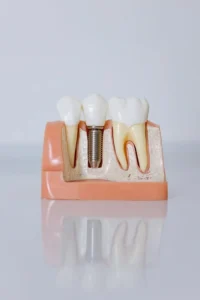 Implantes dentales en Bogotá