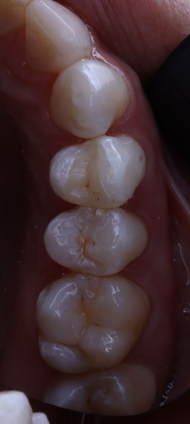Incrustaciones Dentales en Cerámica