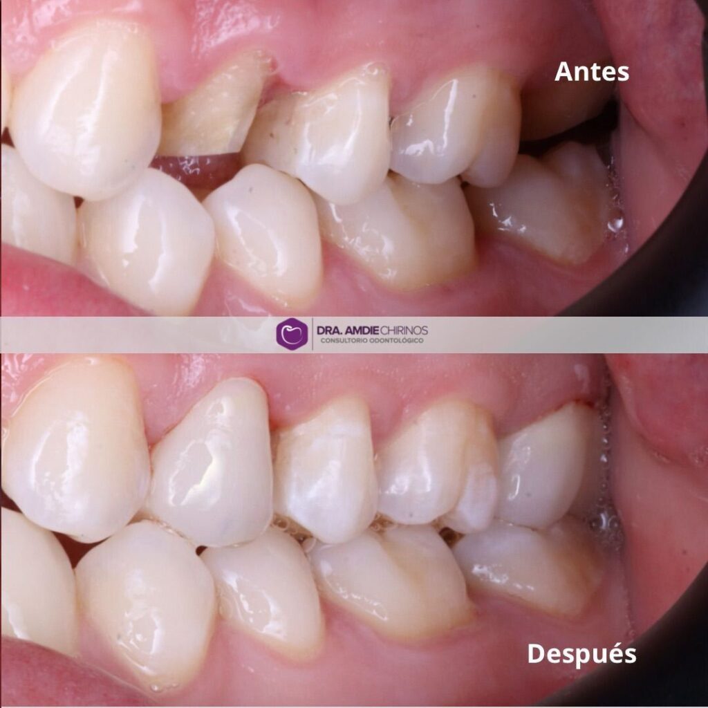 coronas dentales