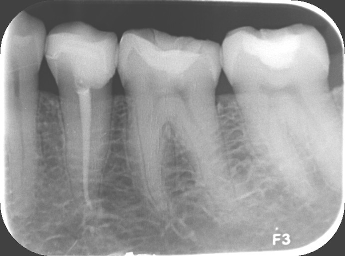 Endodoncia