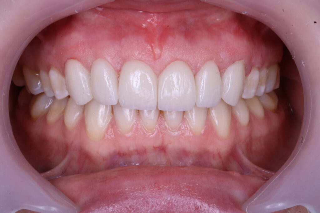 Diseño de Sonrisa en Bogotá​