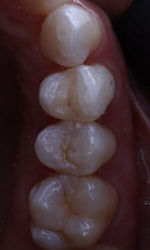 Incrustaciones Dentales en Cerámica